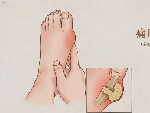 痛風(fēng)的快速止痛的方法