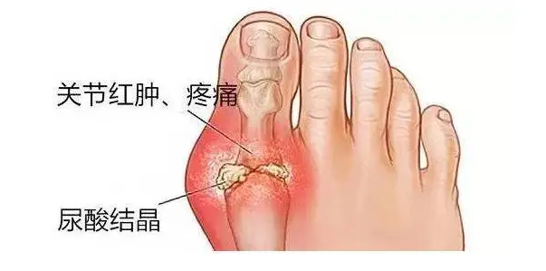 痛風(fēng)會在哪些部位痛，這些部位經(jīng)常發(fā)生