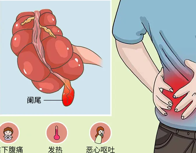 闌尾炎是哪個(gè)部位疼-闌尾炎是哪個(gè)部位疼常見(jiàn)的膿