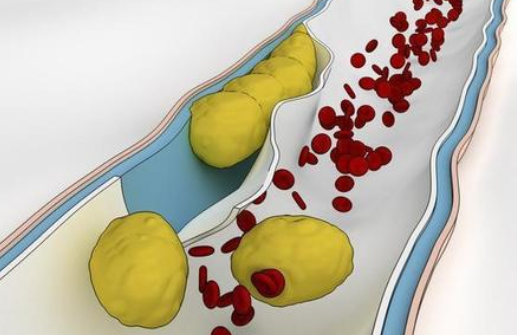 低密度脂蛋白偏高是什么意思