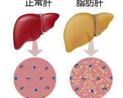 脂肪肝怎么調(diào)理最好最快