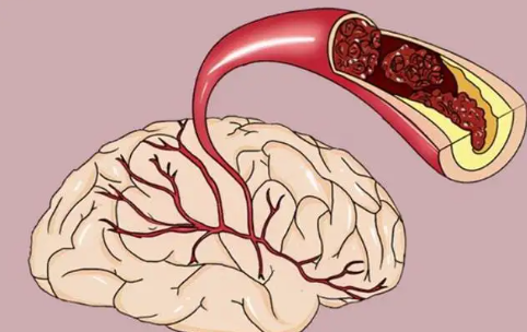 腦供血不足癥狀表現(xiàn)有哪些(腦供血不足癥狀表現(xiàn)有哪些吃什么藥有效)