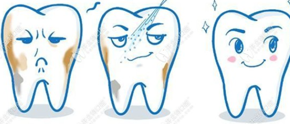 洗牙齒大概多少錢?洗牙多少錢一次呢?一起跟牙結(jié)石說再見