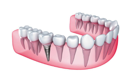 種植牙的五大危害