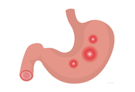 胃潰瘍癥狀表現(xiàn)有哪些（胃潰瘍分為典型癥狀和伴隨癥狀）