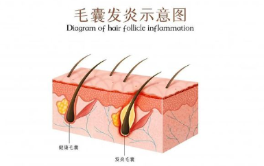 毛囊炎的癥狀