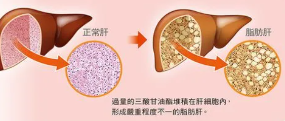 脂肪肝怎么調(diào)理最好最快(脂肪肝怎么調(diào)理最好最快吃什么中藥)