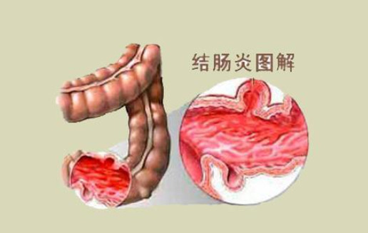 結(jié)腸炎的癥狀有哪些癥狀