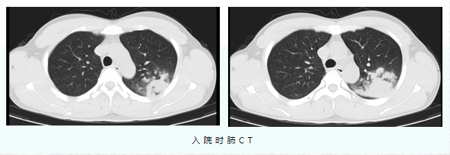 一家3口全部感染 有人肺部現(xiàn)大片炎癥 緊急提醒！